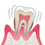 歯周病の進行具合
